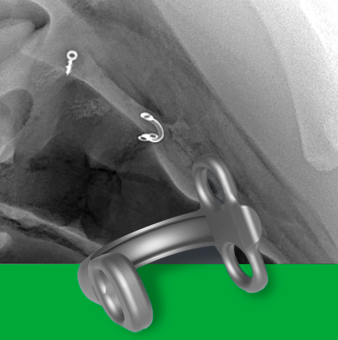 U buttons for larinx surgery