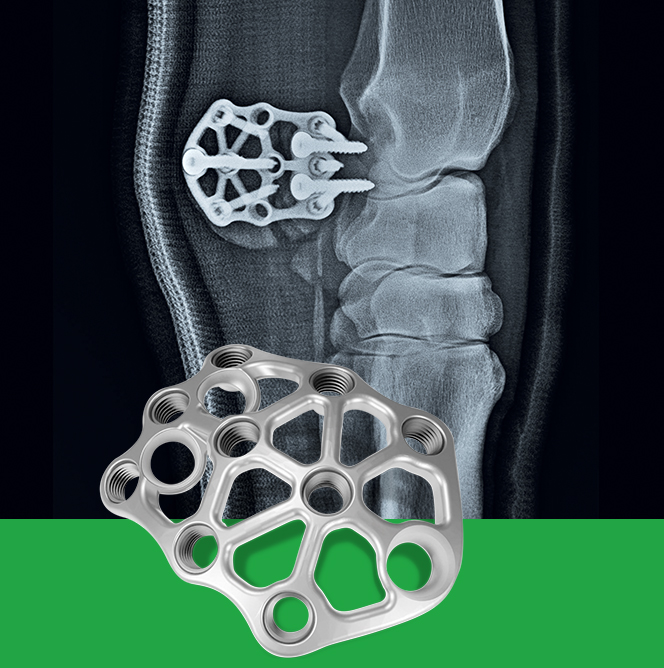 Accessory Carpal bone - X11 plate