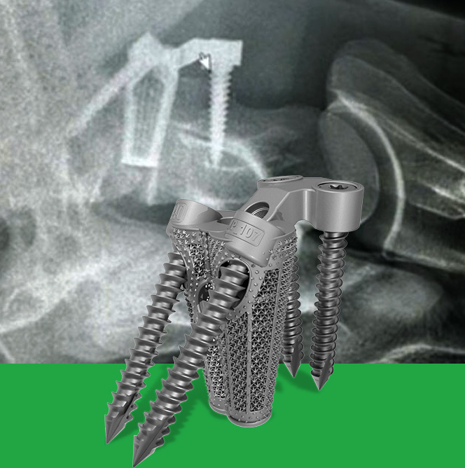 Darkann One for cervical arthrodesis C7-T1 horses